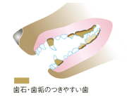 歯石、歯垢のつきやすい歯