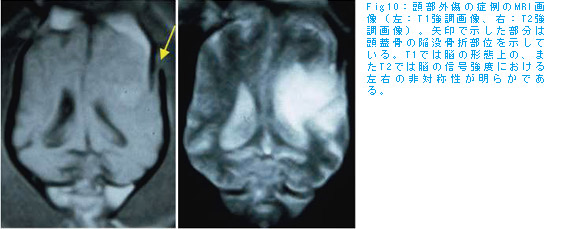 脳の対称性